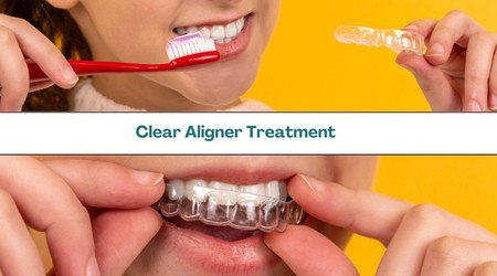 Clear aligner treatment