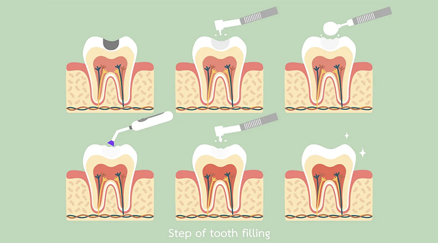 Dental treatment for a tooth filling