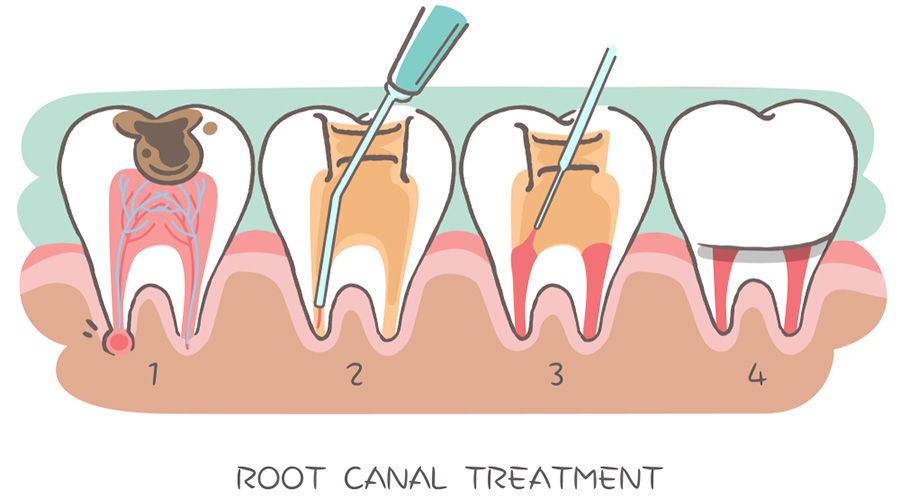 Root canal dental treatment