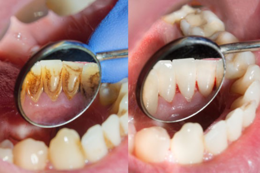 Professional dental scaling and cleaning