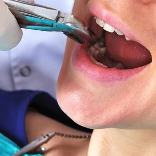 Tooth extraction procedure